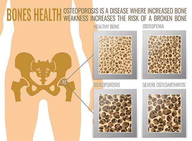 Ilustración que muestra la salud ósea y las cuatro etapas de la osteoporosis.