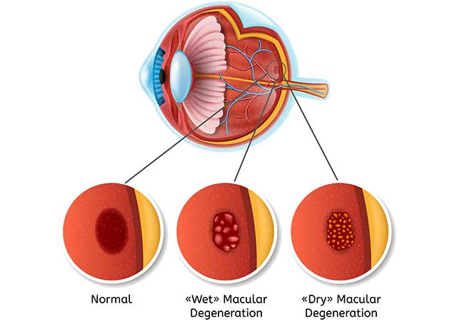Infografía que muestra cómo progresa la degeneración macular.